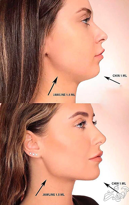 تفاوت زاویه سازی صورت با ژل و چربی  زاویه سازی صورت با ژل بهتره یا چربی, زاویه سازی صورت با ژل, تزریق ژل زاویه فک